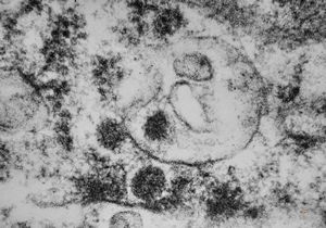 M,2y. | viral particles ? in hepatocyte